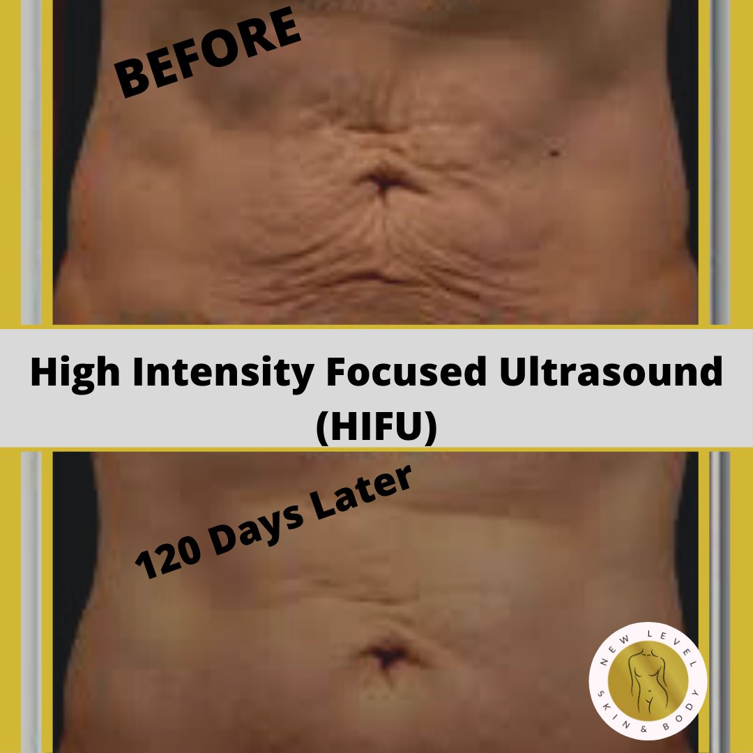 GetinShapeBC's tweet image. HIFU is non-invasive cosmetic skin tightening treatment and the procedure takes less than 45 minutes. newlevelskinandbody.com