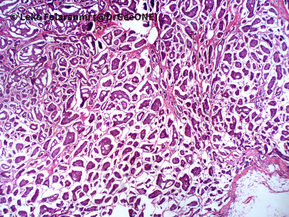 DrGeeONE's tweet photo. 1/2
Recurring “breast” mass post-mastectomy 

🔆Invasive micropapillary carcinoma (IMPC)
✳️~3.8% of invasive breast ca.
-Pure forms are rare (~1% of breast ca). At least 75% of pattern to classify as IMPC
✳️Aggressive (LN and distal mets, local recurrence @QassidO 
#BreastPath https://t.co/Ld3lErFAC0