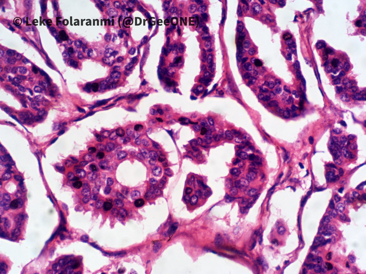DrGeeONE's tweet photo. 1/2
Recurring “breast” mass post-mastectomy 

🔆Invasive micropapillary carcinoma (IMPC)
✳️~3.8% of invasive breast ca.
-Pure forms are rare (~1% of breast ca). At least 75% of pattern to classify as IMPC
✳️Aggressive (LN and distal mets, local recurrence @QassidO 
#BreastPath https://t.co/Ld3lErFAC0