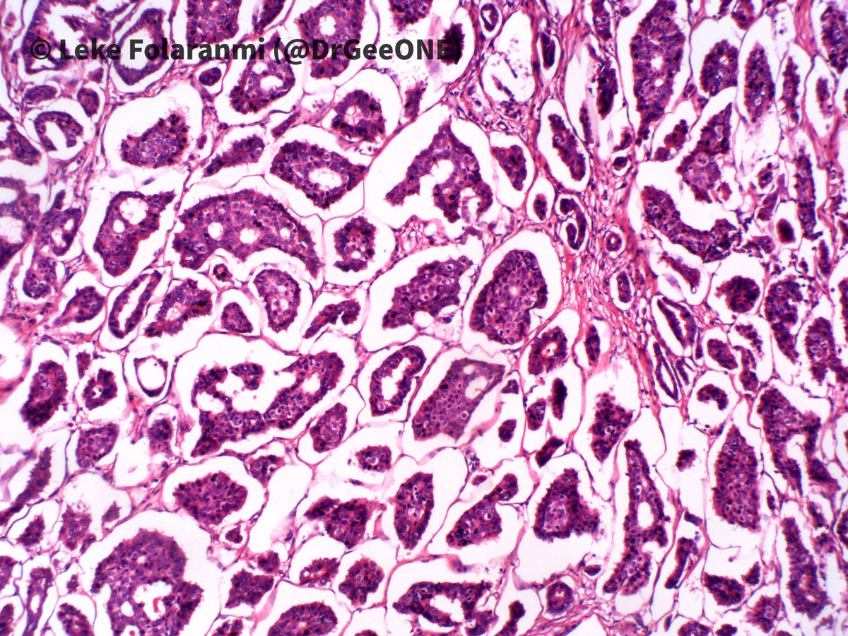 DrGeeONE's tweet photo. 1/2
Recurring “breast” mass post-mastectomy 

🔆Invasive micropapillary carcinoma (IMPC)
✳️~3.8% of invasive breast ca.
-Pure forms are rare (~1% of breast ca). At least 75% of pattern to classify as IMPC
✳️Aggressive (LN and distal mets, local recurrence @QassidO 
#BreastPath https://t.co/Ld3lErFAC0