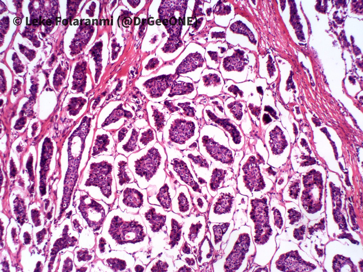 DrGeeONE's tweet photo. 1/2
Recurring “breast” mass post-mastectomy 

🔆Invasive micropapillary carcinoma (IMPC)
✳️~3.8% of invasive breast ca.
-Pure forms are rare (~1% of breast ca). At least 75% of pattern to classify as IMPC
✳️Aggressive (LN and distal mets, local recurrence @QassidO 
#BreastPath https://t.co/Ld3lErFAC0