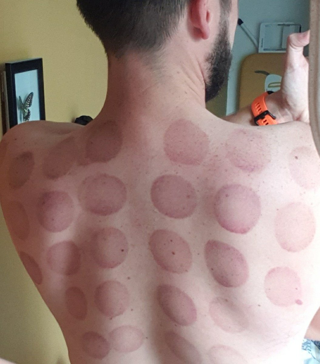 mbulpitt87's tweet photo. Anyone up for a game of connect 4? 
The day after a #Cupping session with @ElementsST 
Feeling so much better having that tension release #Symmetry #SportsTherapy https://t.co/lRqsZyQmhy