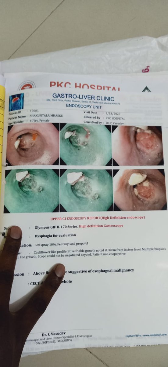 AniketNThakur's tweet photo. Help Shakuntala Raju Mhaske raise funds to fight Oesophagus Cancer* 
 Shakuntala Raju Mhaske is Suffering from Oesophagus Cancer and I am raising funds for her who is suffering from Oesophagus Cancer and is undergoing treatment at LTMGC sion. 
@SonuSood @Rajput_Ramesh https://t.co/fJNvjVUVDU