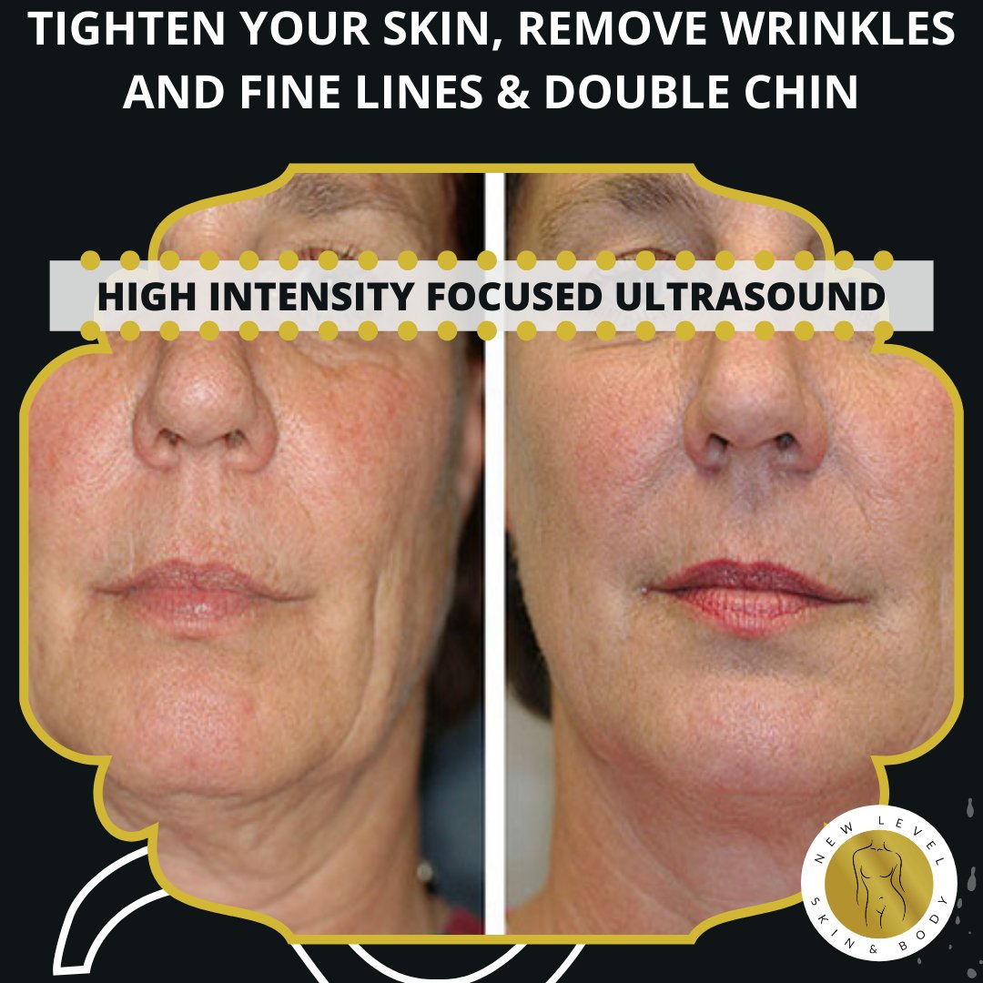 GetinShapeBC's tweet image. Book your appointment or free consultation today to discuss your troubled areas and see if you're a good candidate for HIFU.
Call 702.935.5399 or online newlevelskinandbody.com