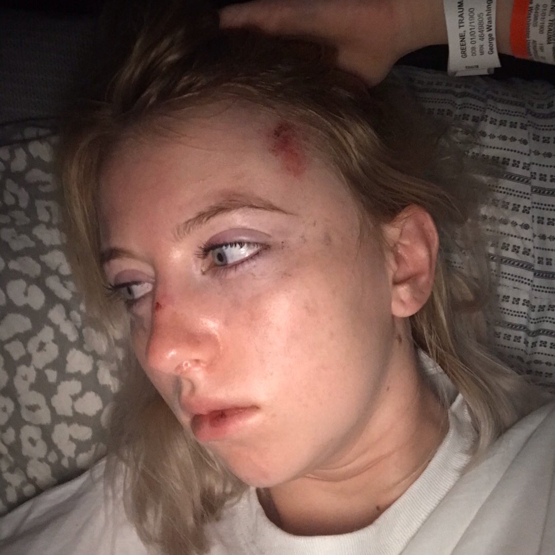 happy anniversary to me and my new face after I scrambled it