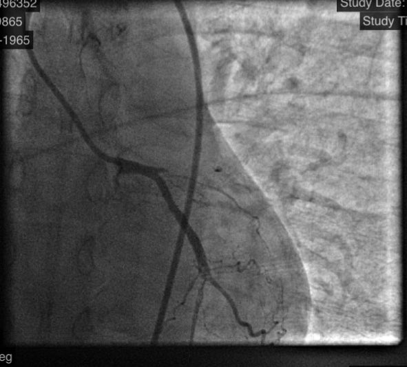 istentem's tweet image. 45f #cardiotwitter #safefemoral ,2 hrs symptoms,3am case, #stemi stent into left main from LAD.no#shock ,no#impella. EF40.#alifesaved