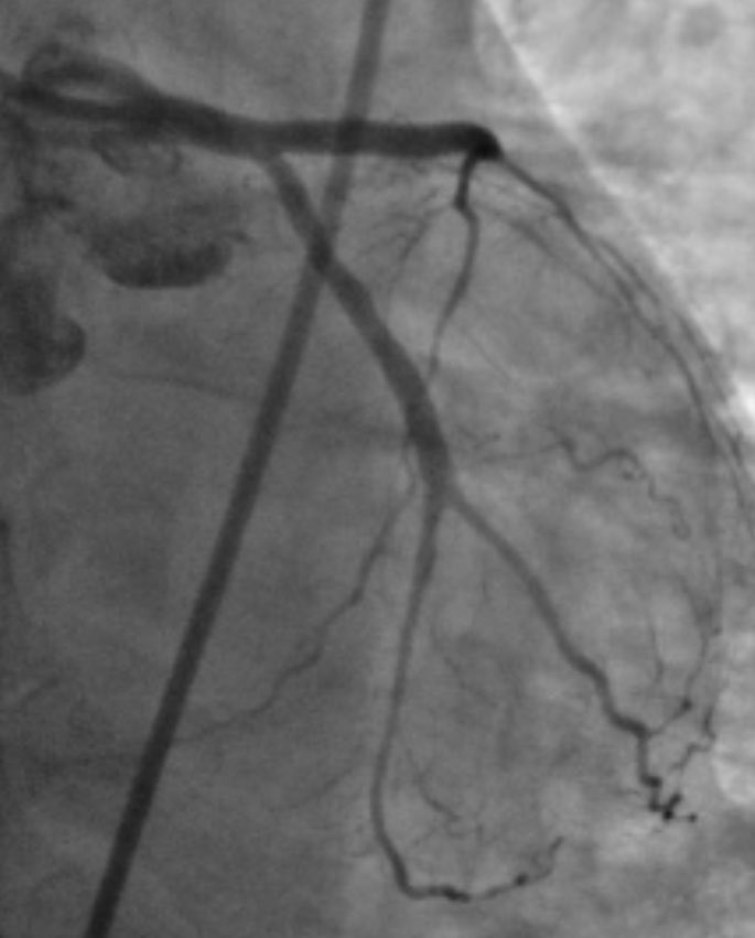 istentem's tweet image. 45f #cardiotwitter #safefemoral ,2 hrs symptoms,3am case, #stemi stent into left main from LAD.no#shock ,no#impella. EF40.#alifesaved