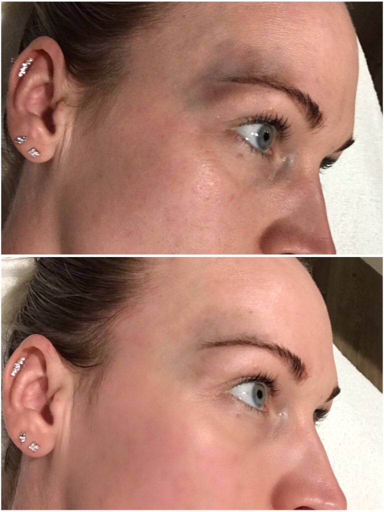 RachRay_Beauty's tweet photo. ♥️LED therapy works⭐️
💫Lighter & brighter in 30mins💫
#rachraybeauty #bruisehealing #brighterskin #lightenredness #redled #lunchtimeled https://t.co/EhWKglooQq