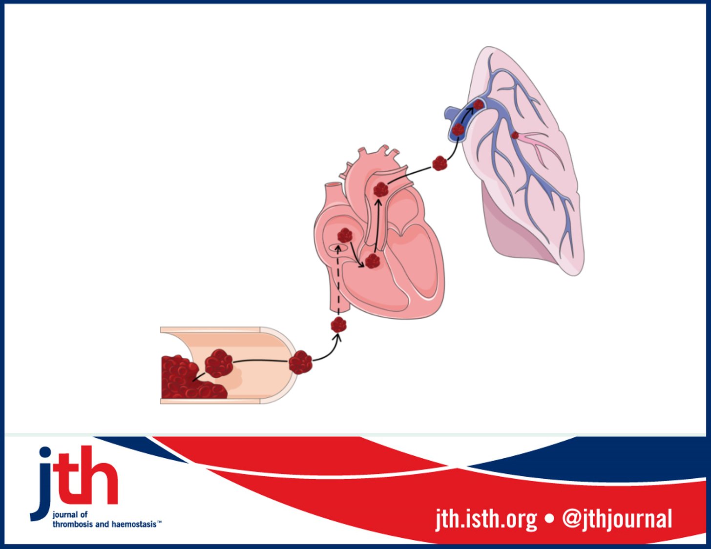 Novel PET Tracer Detects Small Blood Clots