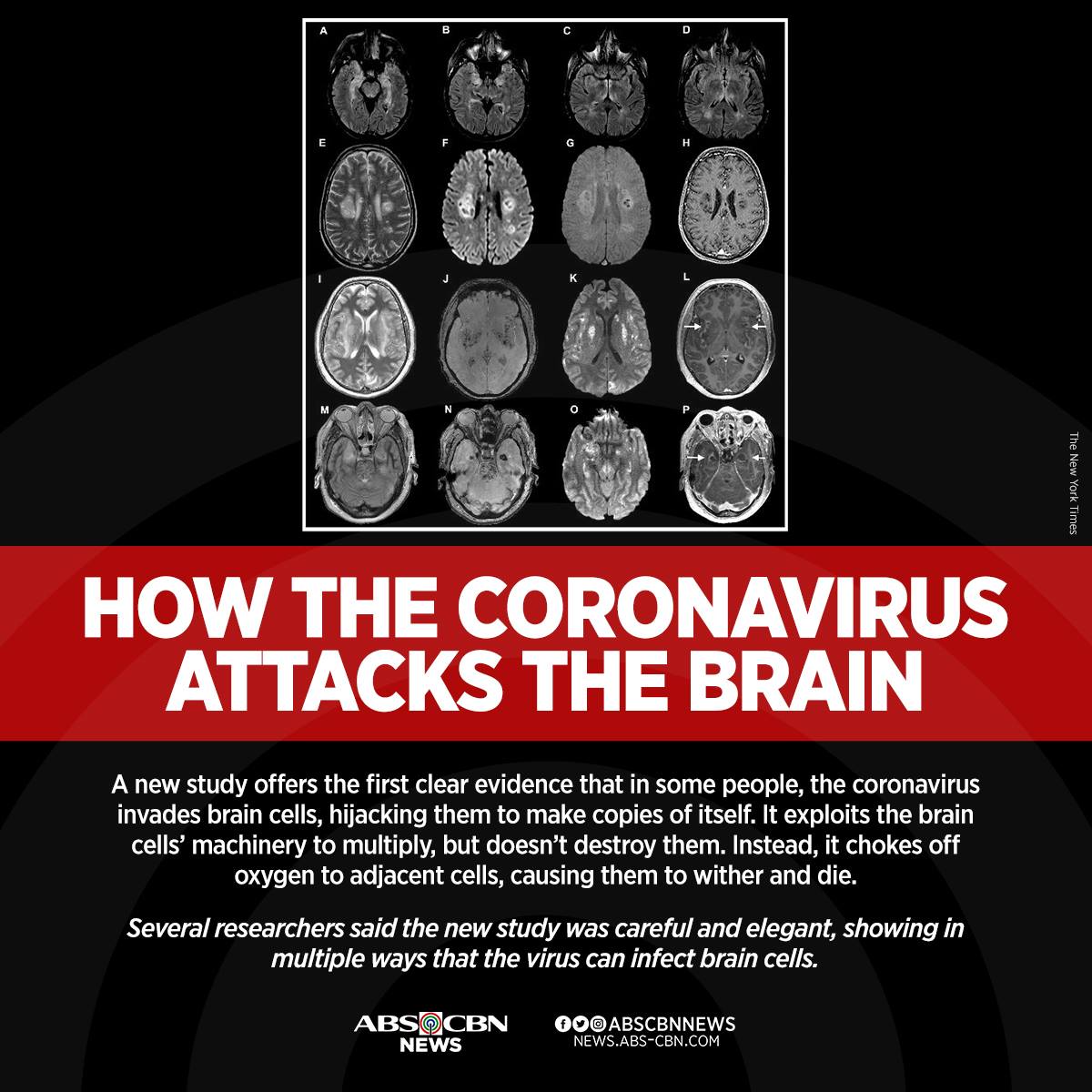 ABSCBNNews's tweet photo. An immunologist warned that if the brain gets infected with SARS-CoV-2, it could have lethal consequences. #COVID19  

READ: https://t.co/Mv05HbVsDv https://t.co/hOdv2D0p74