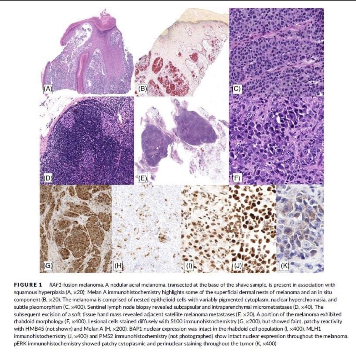 KonstantinosLin's tweet photo. Our new work is out! A novel fusion in an acral melanoma with potential therapeutic implications. Dartmouth in collaboration with MD Anderson Cancer Center https://t.co/7RgOAJozUi #melanoma #dermpath #cancer #oncology #dermatology https://t.co/vtGaYmdcWQ