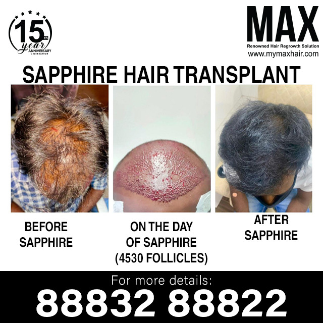 Miracles are not contrary to nature!
Get Natural hair with advanced Sapphire hair transplant method!
👉 No-side effects
👉 Natural looking results
👉 Affordable Price
👉 Eliminate balding
#maxhaircare #sapphirehairtransplant #baldnesssolution #haircare