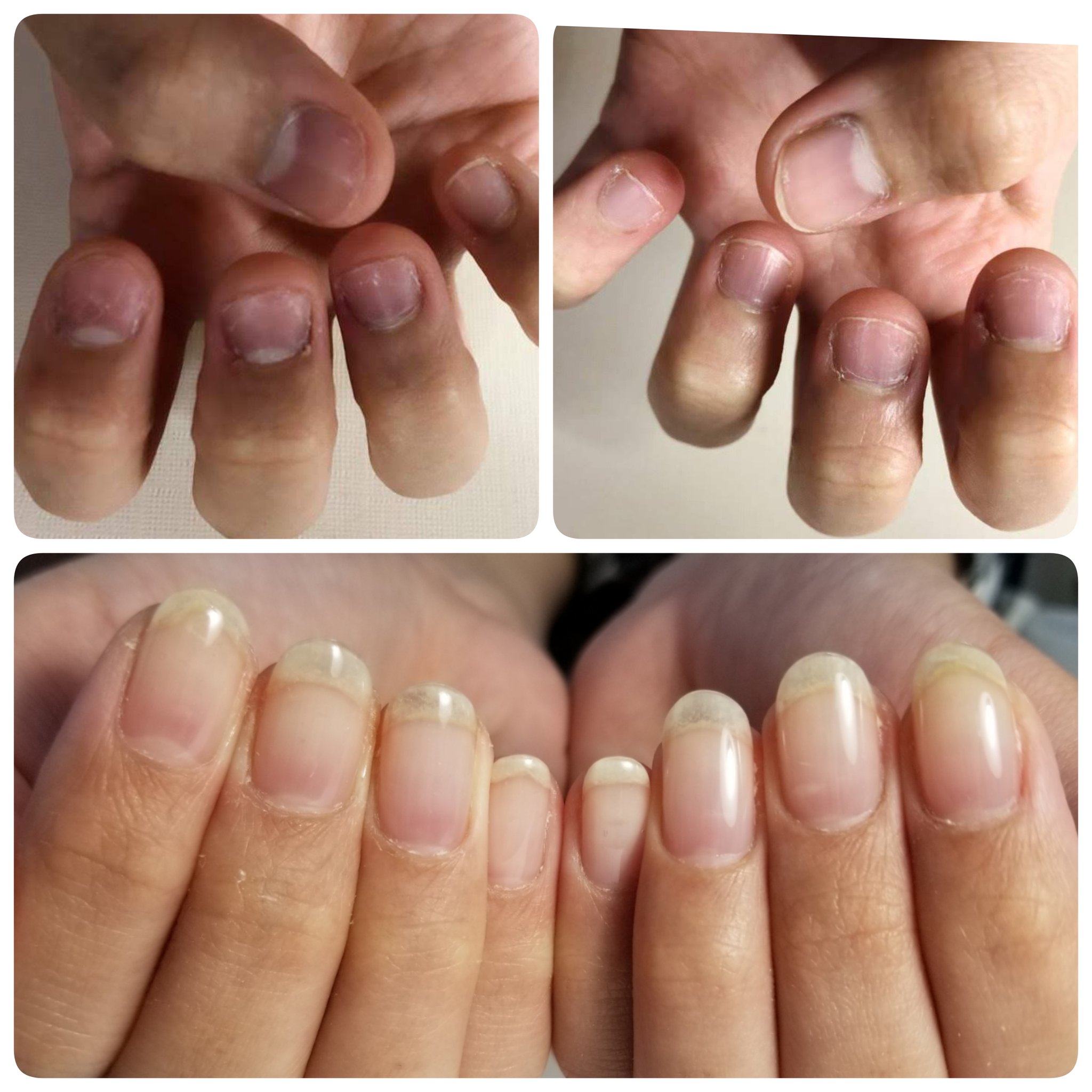 Twitter 上的 自爪育成 深爪緩和専門ネイルサロン このみ こんなに変われたの 素晴らしい ビフォーアフター 自爪育成 深爪緩和 地爪育成 T Co 8zfeleemds Twitter