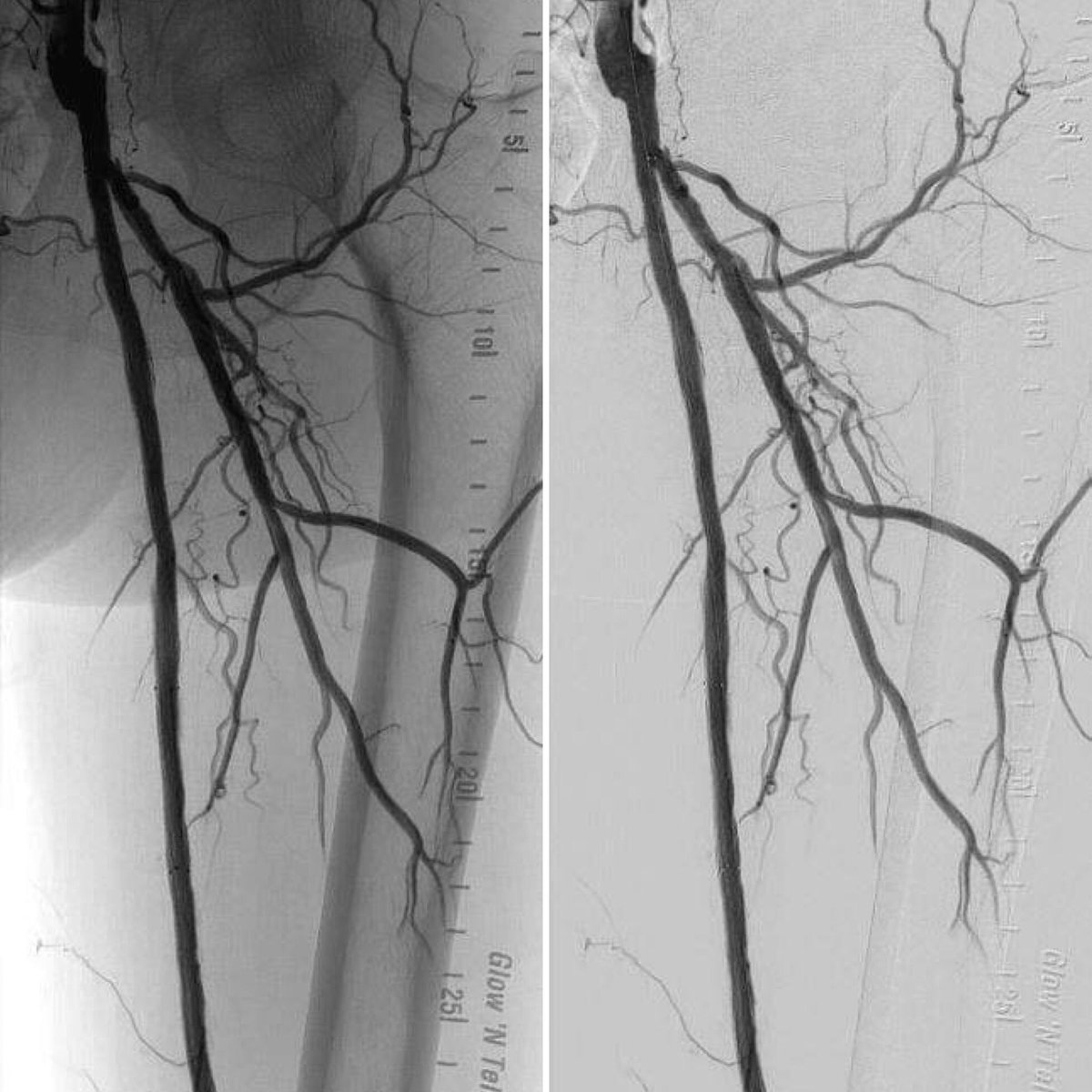 ProleneQueen's tweet photo. Rest pain &amp; prior aortobifemoral bypass. SFA recanalization w/angioplasty &amp; stenting, along w/ popliteal angioplasty from the radial artery. Palpable PT pulse now. Happy patient 😊

#comprehensivevascularcare #withandwithoutascalpel 🔪#ILookLikeASurgeon 💪🏼#lovewhatyoudo 😷 https://t.co/dl5xRzzr72