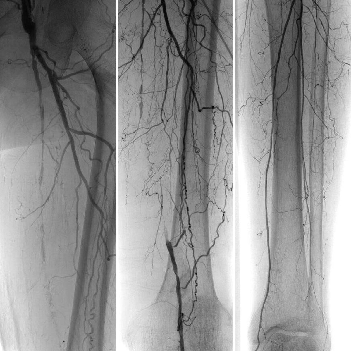 ProleneQueen's tweet photo. Rest pain &amp; prior aortobifemoral bypass. SFA recanalization w/angioplasty &amp; stenting, along w/ popliteal angioplasty from the radial artery. Palpable PT pulse now. Happy patient 😊

#comprehensivevascularcare #withandwithoutascalpel 🔪#ILookLikeASurgeon 💪🏼#lovewhatyoudo 😷 https://t.co/dl5xRzzr72
