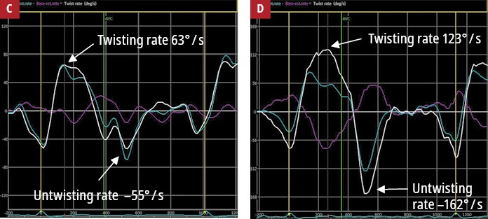 heart_polish's tweet photo. Editors’ Insights: Nonroutine use of 2D #speckle #tracking #echocardiography and fatigue assessment to monitor the effects of therapeutic #venesections in hereditary #hemochromatosis.

https://t.co/fH4HcGI55U #PolishHeartJournal #cardiotwitter #HeartNews @Rzecznik_GUMed https://t.co/chIyjtaw2P
