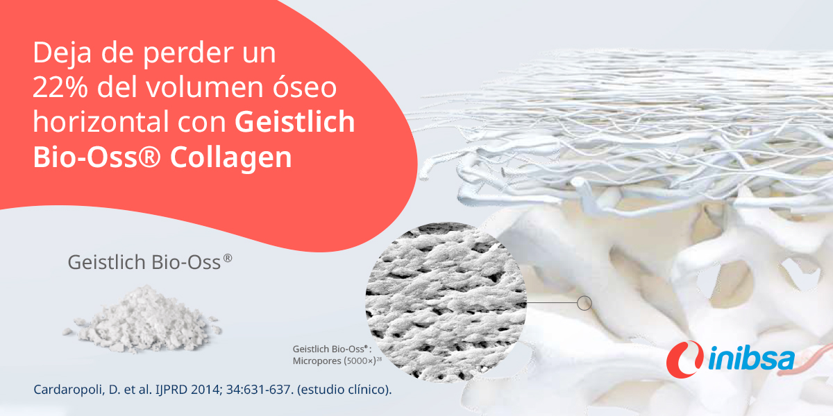 inibsadental's tweet photo. Si no rellenas el gap periimplantario con Geistlich Bio-Oss® Collagen estás perdiendo un 22% del volumen óseo horizontal. 🦷🤗
#Inibsa #SectorDental #SimpleSmartSolutions #CirugiaDental #RegeneracionDental https://t.co/6nvVt9fePs