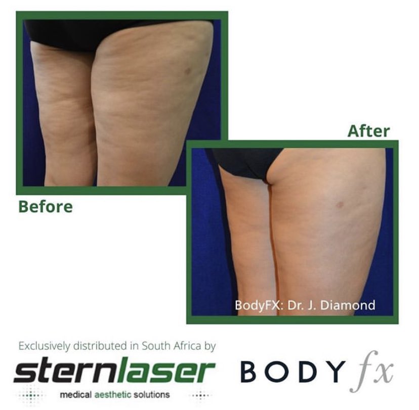 SternlaserSA's tweet photo. Goodbye cellulite with #bodyFX by @InModeSolutions
#sternlaser #aestheticpartner https://t.co/k6vRAhyp5E