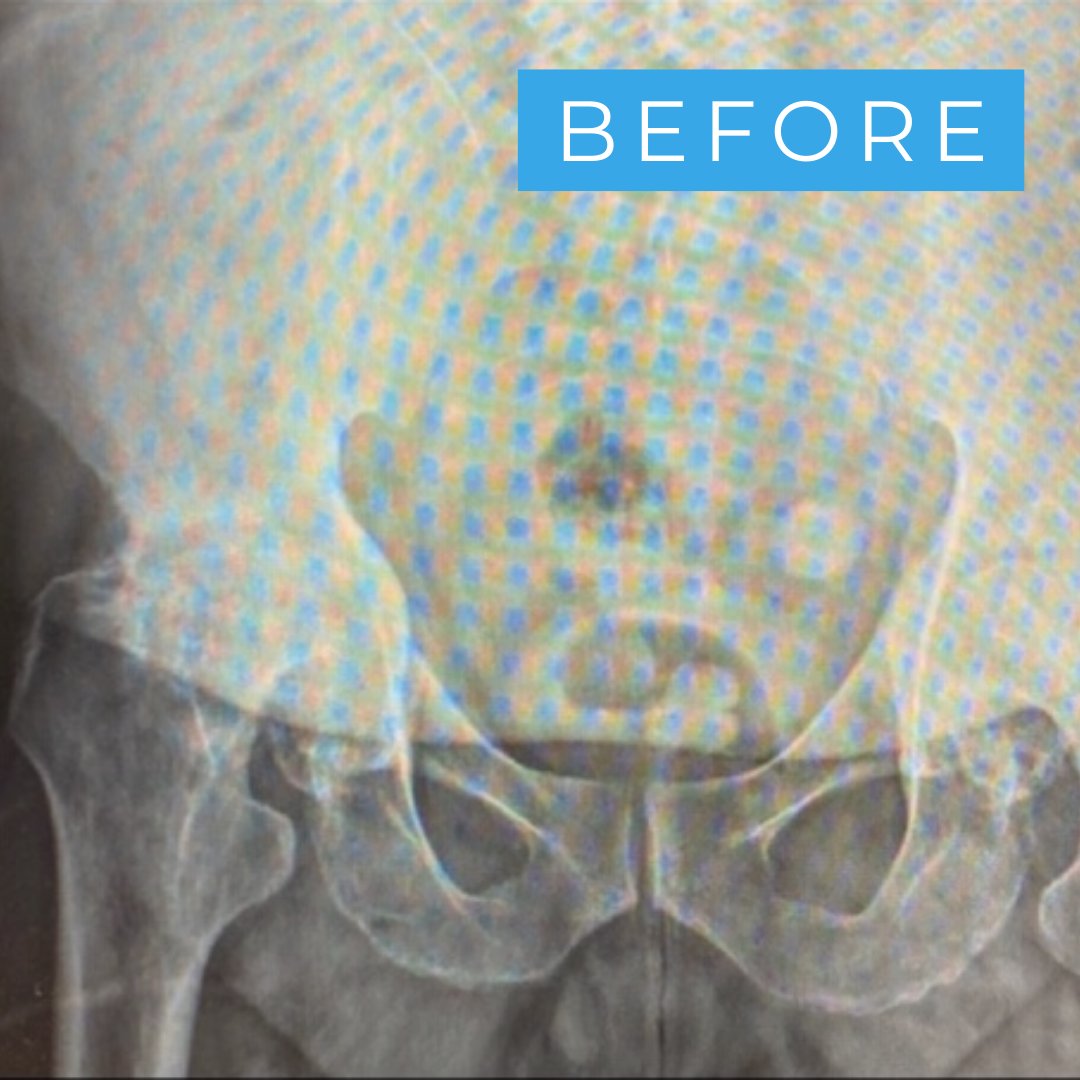 OMGTampaBay's tweet photo. ✏️CASE STUDY:  Patient had developed avascular necrosis to both hips at a young age, which quickly went on to horrible arthritis. @drgoldsmith performed a total #hipreplacement using press fit acetabular shell &amp; femoral stem and ceramic head 🛠️🦴🔩   #orthopaedics #orthotwitter https://t.co/V8fLODYGwh