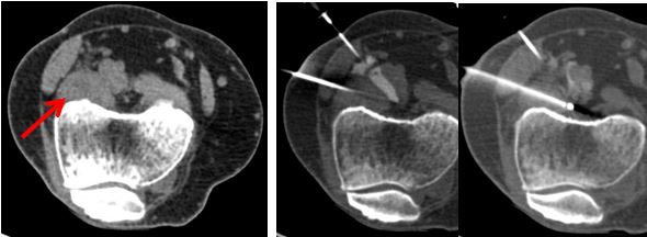 BIDMCVIR's tweet photo. Dx: PVNS; Tx: resection (w/recurrence), sharp pain (8/10) w/little relief from NSAIDS/steroid injections; #IRad consulted; ablation performed w/ hydrodisplacement of adjacent vessels w/2.5% dilute contrast; RF ablation performed w/ 3cmx17g cooled probe @ 12 min #BIDMCVIRCaseFiles https://t.co/lkN2M5wnZo