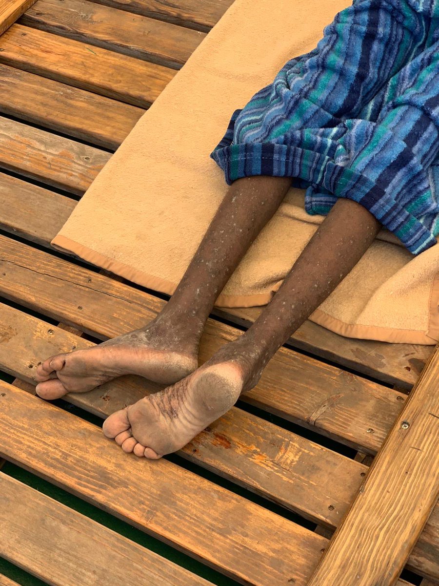 openarms_fund's tweet photo. Sarna, esa vieja enfermedad, que habla por sí sola de las condiciones infrahumanas que las personas que rescatamos #Med han sufrido en #Libia. Son víctimas de las peores torturas, de abusos y extorsiones sistemáticas y de la esclavitud. 
#cadavidacuenta #volvemosalmar https://t.co/TdjeDL0PX7