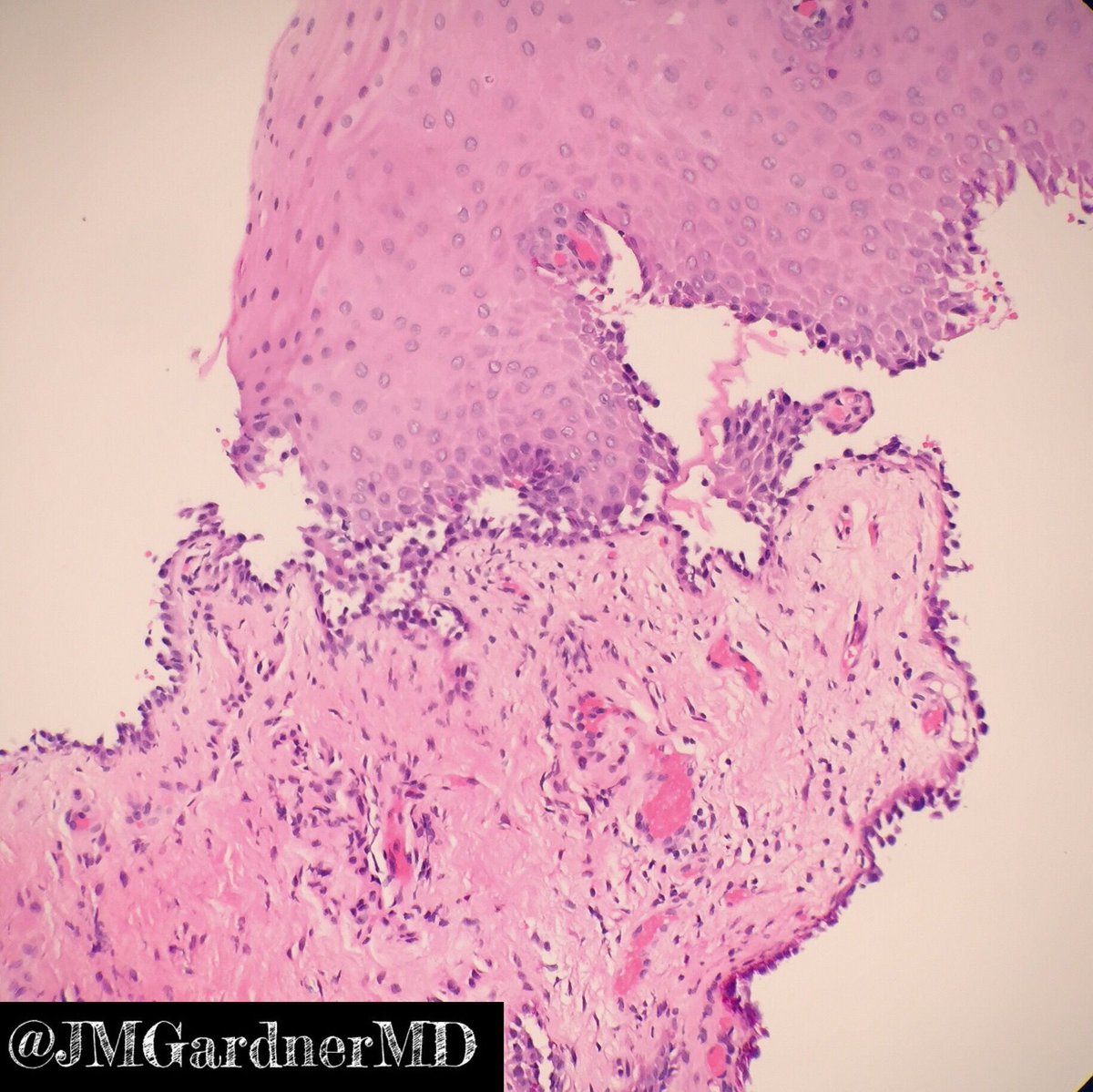 JMGardnerMD's tweet photo. Pemphigus vulgaris: Acantholytic suprabasilar blister. Fishnet IgG & C3 on DIF (autoantibodies target desmogleins 1&3). Learn my basic approach to blistering skin diseases in my #dermpath #pathsurvivalguide by @innovpathpress: https://t.co/85dyJi37nn #pathology #dermatology https://t.co/yN0FedkTds