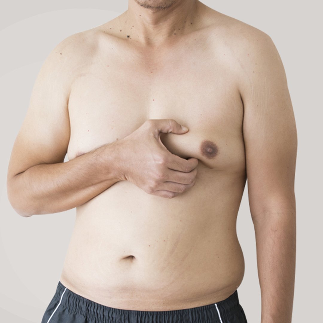 BodiMedic's tweet photo. Gynecomastia repair, or male breast reduction in Edmonton
Book Appointment Now - https://t.co/Hy21Ha4daa
#CoolContouring #coolsculpting https://t.co/QEfHQNucIt