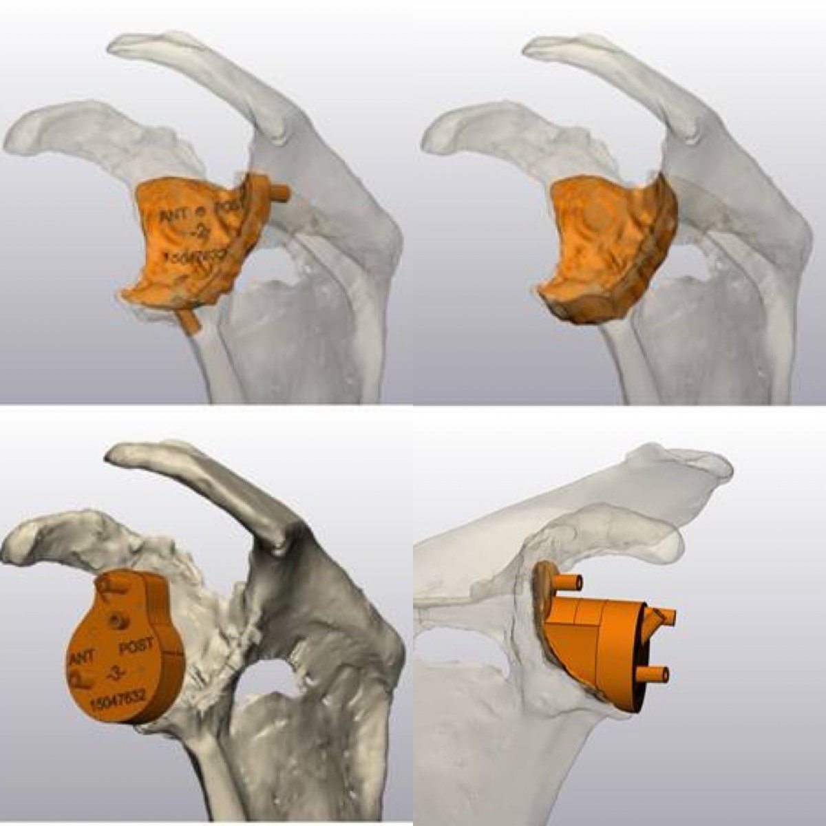 JayMorris_MD's tweet photo. Engineers becoming part of the clinical team makes treatments possible in real time. @hunterdickens9 works closely w/ Dr Mark Morrey @MayoOrtho to provide custom #3Dprinted surgical guides for complex #shoulder reconstructions manufactured in house. #orthotwitter @MayoInnovation https://t.co/2AGDqUufqy