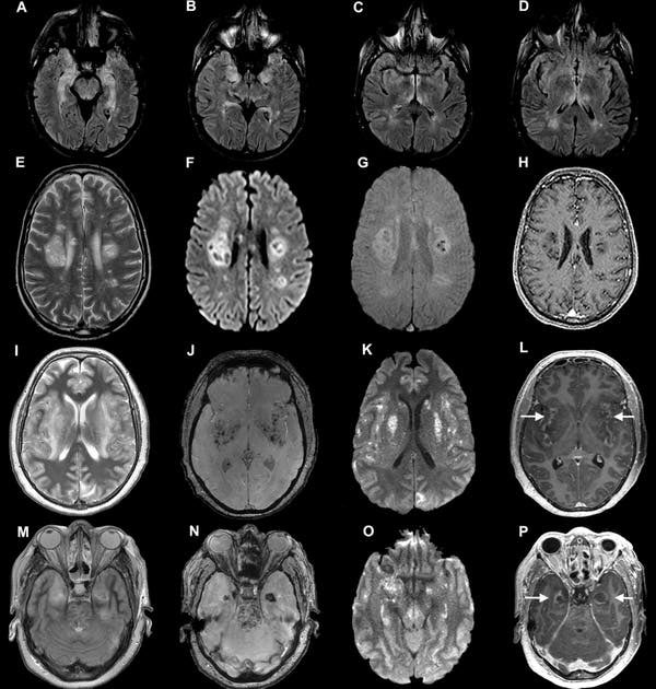 COVID & BRAIN damage—half of patients report neurological symptoms, including headaches, confusion and delirium. A new study offers the first clear evidence that, in some people, the coronavirus invades brain cells.  #COVID19  https://www.nytimes.com/2020/09/09/health/coronavirus-brain.html