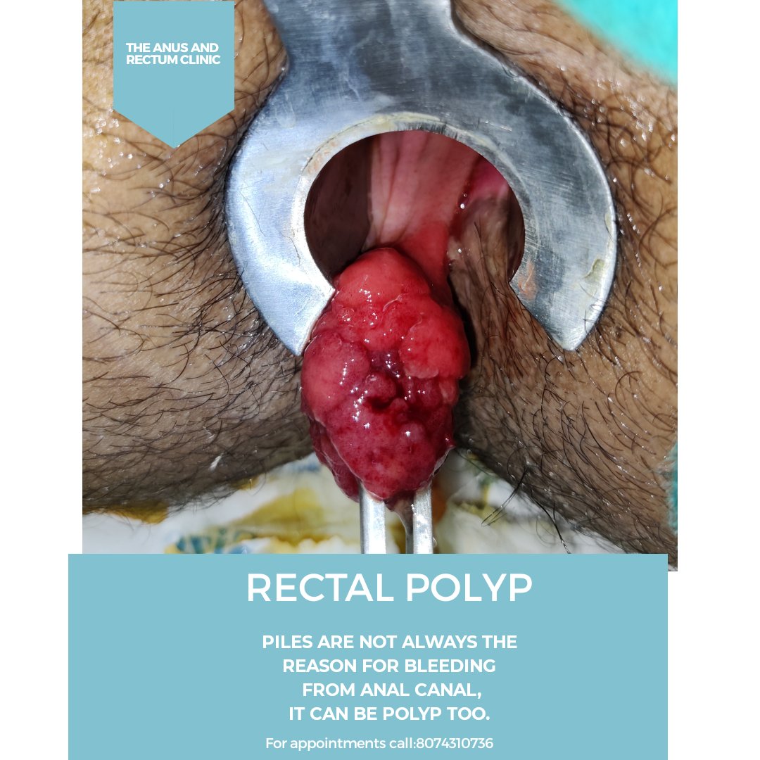 rectal polypectomy