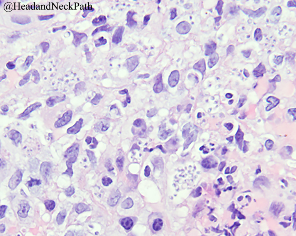 Unique Oral Presentations of Deep Fungal Infections: A Report of Four Cases by Vimi S. Mutalik, Caroline Bissonnette, John R. Kalmar &amp; Kristin K. McNamara
rdcu.be/b6Wir
#HeadNeckPathol #HNPJ #HeadandNeckPath #Pathology #ENTPath #PathologyTweet