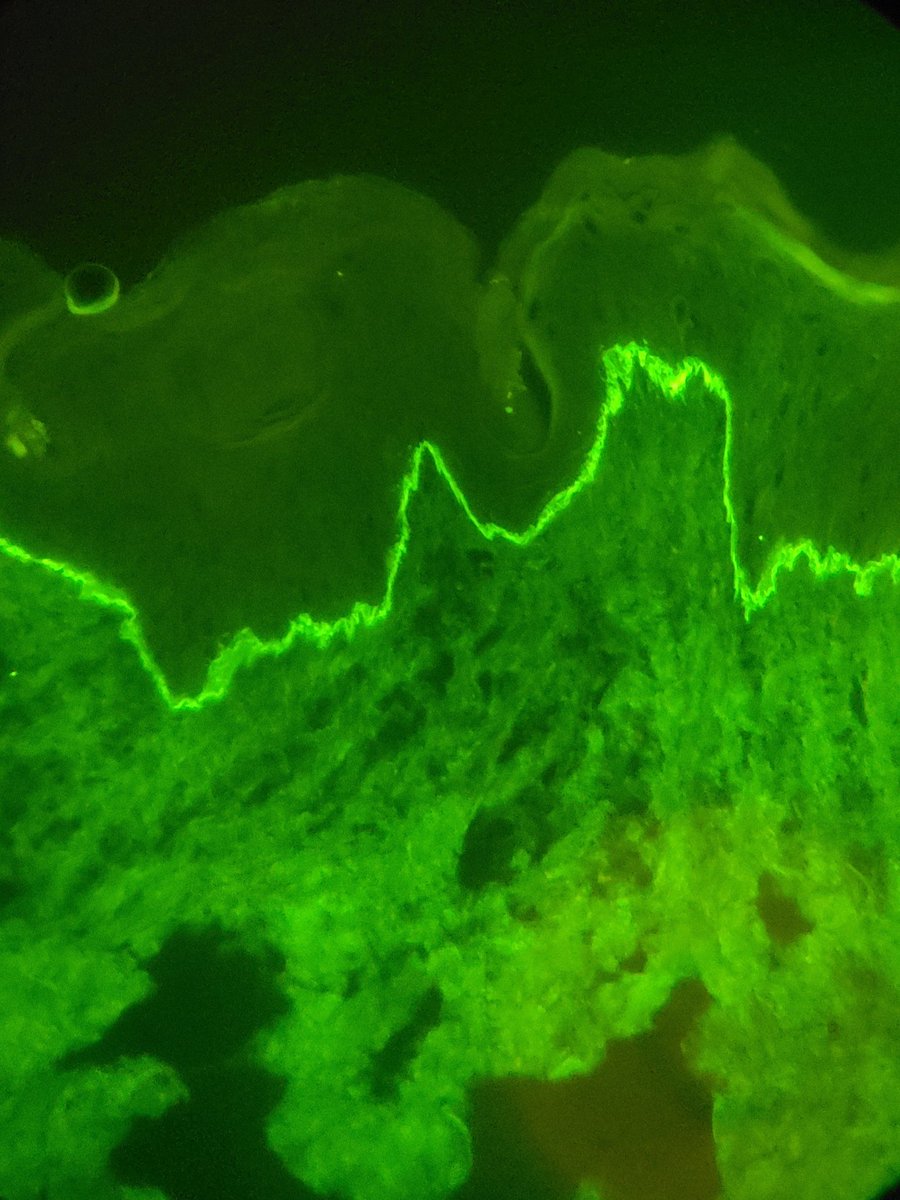 MCG_Pathology's tweet image. A recent case seen by @MattPowellMD, elderly patient with months of itching and now tense bullae.  What antibodies could this be? #PathTwitter #path2path #PathMatch21