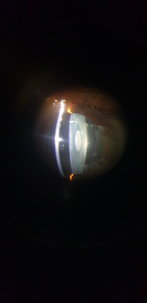 #hiddenknowledge #invisibletotheeye
Do you see this #hidden #cataract in the #eye?
25 years old female with complaints of mild #blurring of #vision. No history of #steroid use. VA - OU 20/40.

#eyecare101 #eyecare  #eyehospital #besteyedoctor  #sankalphospital #ambikapur