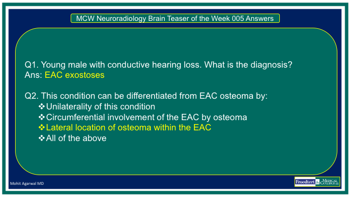 PublishedXPrime's tweet photo. #MCWNeuroradBTW 005 Ans: EAC Exostoses

Check out the #TeachingMoment: exostoses Vs osteoma!

Thanks to all those who participated!

@RGovindiah @Jaswal_Shama @bdoop3210 @DhruvPatel1502 @EricRSmithMD @YPekcevik @SivaGaddam 

#FOAMed #FOAMrad #radres #MedEd #RadEd #HNRad https://t.co/S7kH6sESCs
