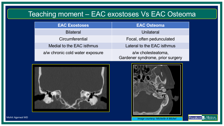 PublishedXPrime's tweet photo. #MCWNeuroradBTW 005 Ans: EAC Exostoses

Check out the #TeachingMoment: exostoses Vs osteoma!

Thanks to all those who participated!

@RGovindiah @Jaswal_Shama @bdoop3210 @DhruvPatel1502 @EricRSmithMD @YPekcevik @SivaGaddam 

#FOAMed #FOAMrad #radres #MedEd #RadEd #HNRad https://t.co/S7kH6sESCs
