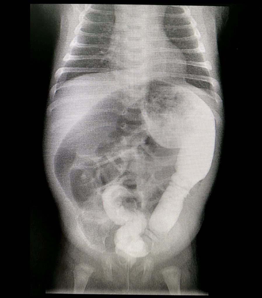 10bladeae's tweet photo. Happy #FIOFriday 🎉! Abdominal X-Ray in a 2 year old. Can you see what we see? >>>> answer through HERE https://t.co/TvC8VNxs1l #FIOF #10blade #MedTwitter #surgery #pediatricsurgery #Dubai #uae #surgicalresident #SoMe4Surgery @Cirbosque https://t.co/hdoPGjQUcr
