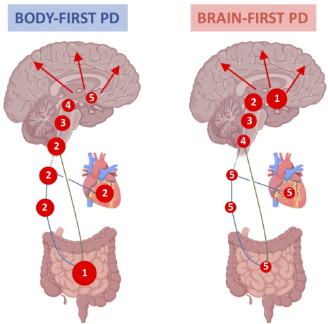 Brain1878's tweet image. Horsager et al. present evidence for the existence of two subtypes of Parkinson's disease: 'brain-first', which starts in the brain and propagates downwards, and 'body-first', which originates in the ANS of the gut and spreads to the brain. bit.ly/34OaU59