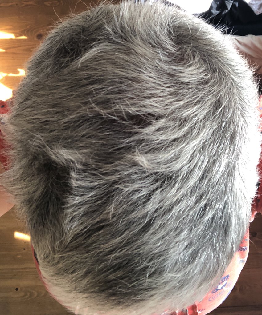 stcathhatch's tweet photo. Post chemo hair. 4 months post my last chemo. New me is emerging. #chemo #ovariancancer #goinggreygracefully https://t.co/uL8awmj5RG