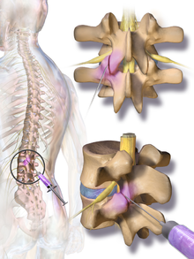 FNeirami's tweet photo. FACET JOINT INJECTIONS
The facet joints, found on both sides of the back of the spine, can become painfully irritated or inflamed. A facet joint injection may help diagnose the source of a patient’s pain. It can also relieve pain and inflammation.

#facet #facetjoint #pain https://t.co/t8bQ5ovPEy