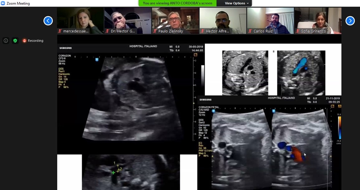 FHospitalaria's tweet image. Ante un muy buen nivel de concurrencia, el pasado 2 de septiembre se realizó vía Zoom una nueva Master Class Online de Ecocardiografía Fetal, auspiciada por Fundación Hospitalaria y organizada por la Fundación Cardioinfantil.
facebook.com/fundhospitalar…