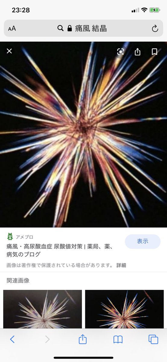 渡久山 孝洋 糸色叫上映前説家 Auf Twitter 痛風の結晶 そりゃあ酒やめますわ 渡久山 孝洋 糸色叫上映前説家 Auf Twitter 痛風の結晶 そりゃあ酒やめますわ