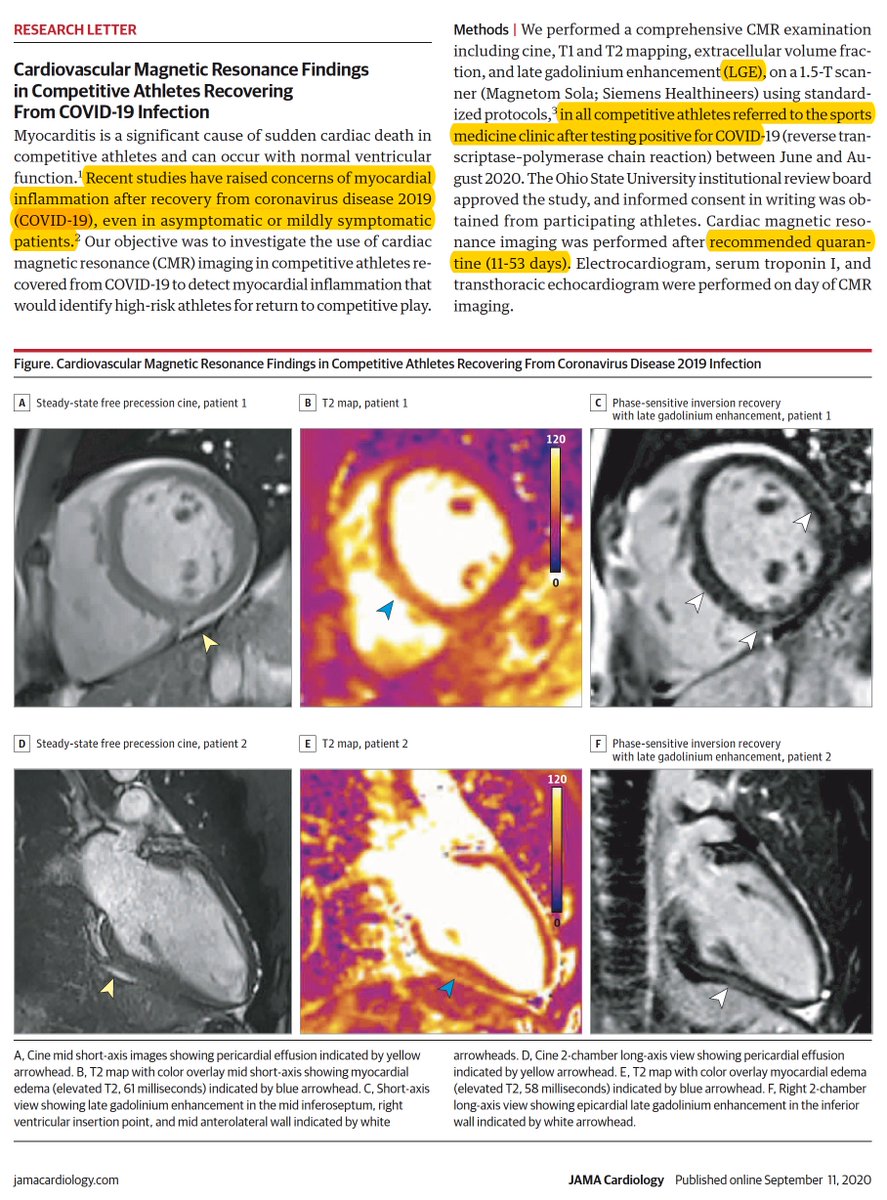 Myocarditis w/  #COVID19 4 of 26 (15%)  @OhioState competitive athletes w/ positive  #SARSCoV2 PCR tests had MRI signs of myocarditis and 8 (31%) findings suggestive of heart injury @JAMACardio today by  @SaurbhRajpal  @OSUWexMed  https://jamanetwork.com/journals/jamacardiology/fullarticle/2770645