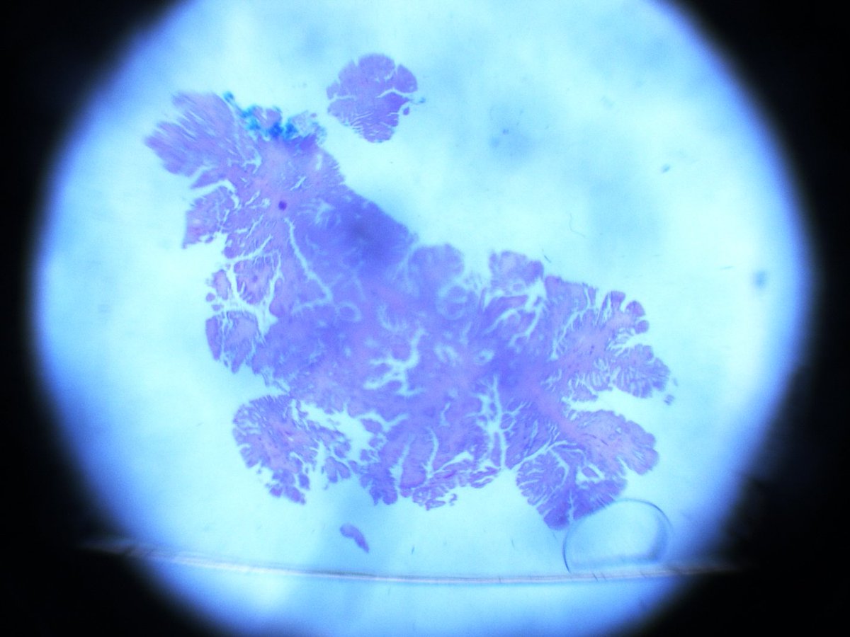 Dear Tweeples, help please. 20mm polyp in sigmoid colon in a background of longstanding mildly active IBD . Is it DALM? Is it Sporadic adenoma? How would you grade it? Any ancillary tests that may add value ? #GIpath  #pathologyresidents .more images.  @RunjanChetty  @MAHoureih