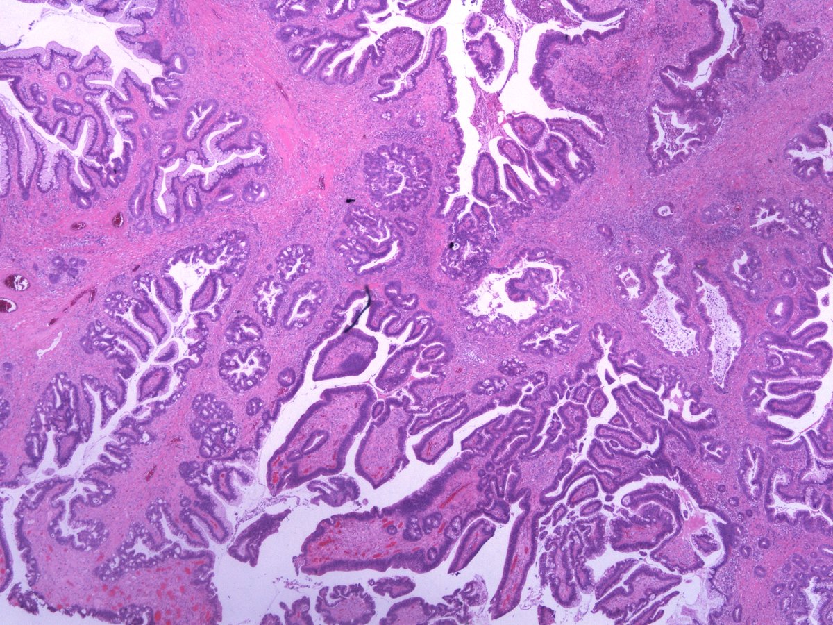 Dear Tweeples, help please. 20mm polyp in sigmoid colon in a background of longstanding mildly active IBD . Is it DALM? Is it Sporadic adenoma? How would you grade it? Any ancillary tests that may add value ? #GIpath  #pathologyresidents .more images.  @RunjanChetty  @MAHoureih