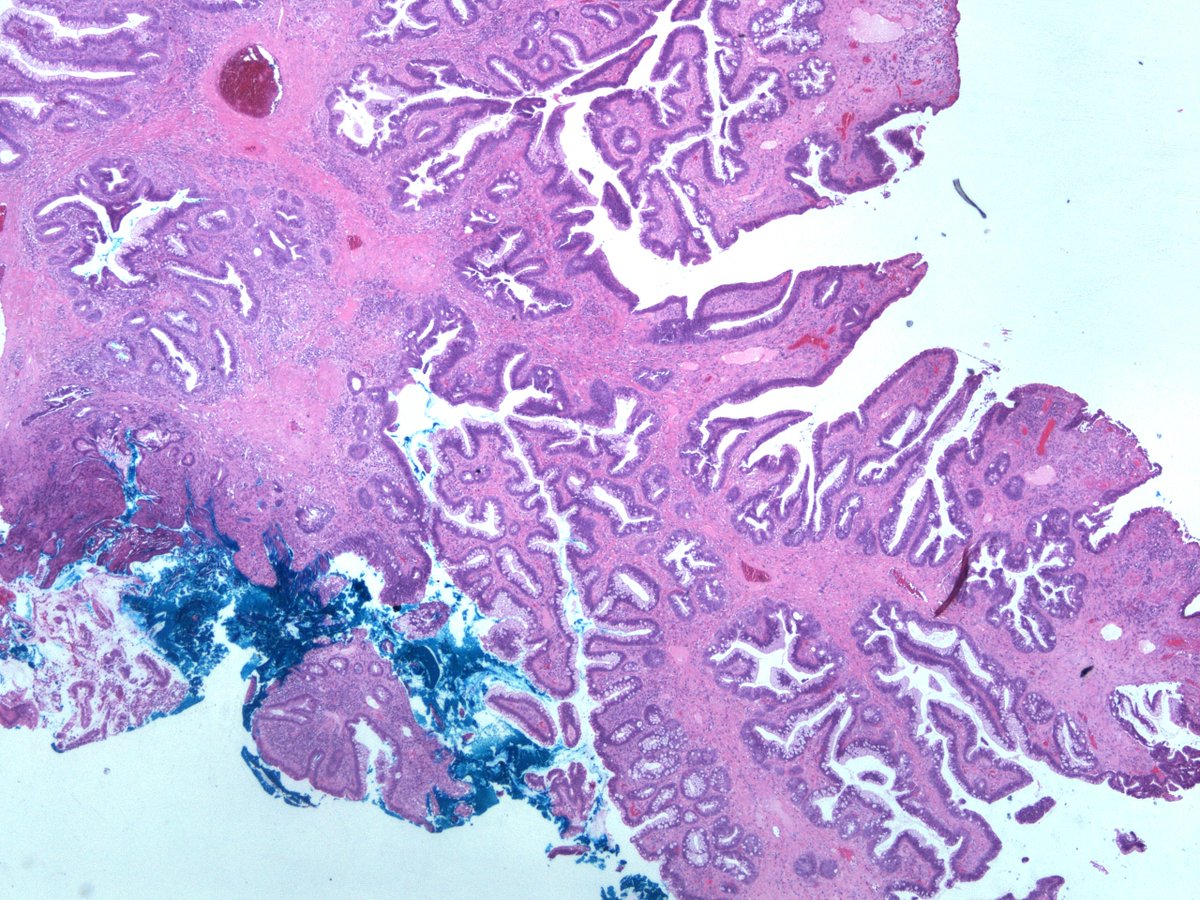 Dear Tweeples, help please. 20mm polyp in sigmoid colon in a background of longstanding mildly active IBD . Is it DALM? Is it Sporadic adenoma? How would you grade it? Any ancillary tests that may add value ? #GIpath  #pathologyresidents .more images.  @RunjanChetty  @MAHoureih