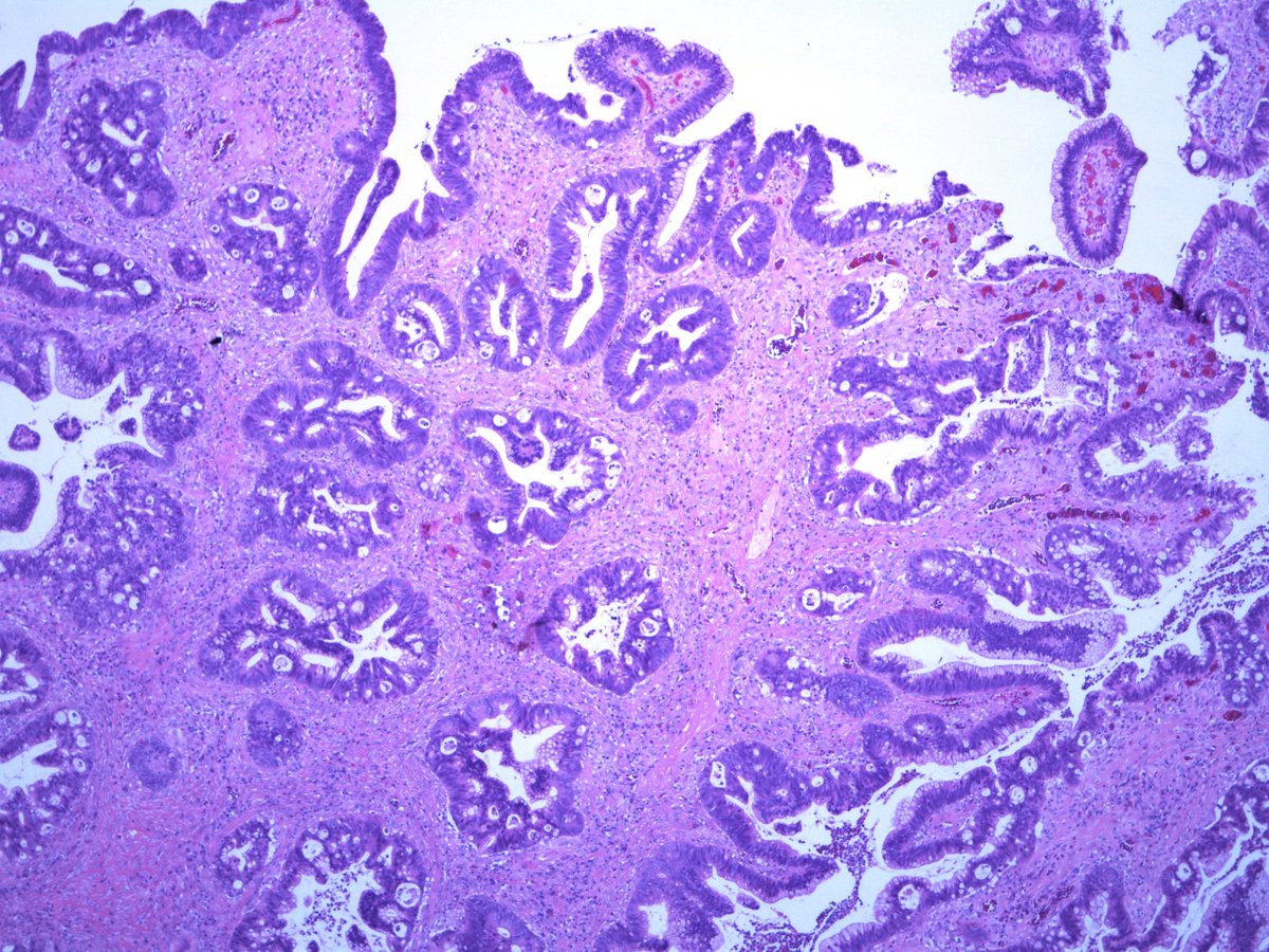 Dear Tweeples, help please. 20mm polyp in sigmoid colon in a background of longstanding mildly active IBD . Is it DALM? Is it Sporadic adenoma? How would you grade it? Any ancillary tests that may add value ? #GIpath  #pathologyresidents .more images.  @RunjanChetty  @MAHoureih
