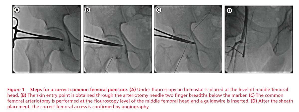 gbiondizoccai's tweet image. Don't miss this comprehensive review on #Perclose #ProGlide: 
Perclose Proglide for vascular closure, by Del Prete et al
futuremedicine.com/doi/10.2217/fc…