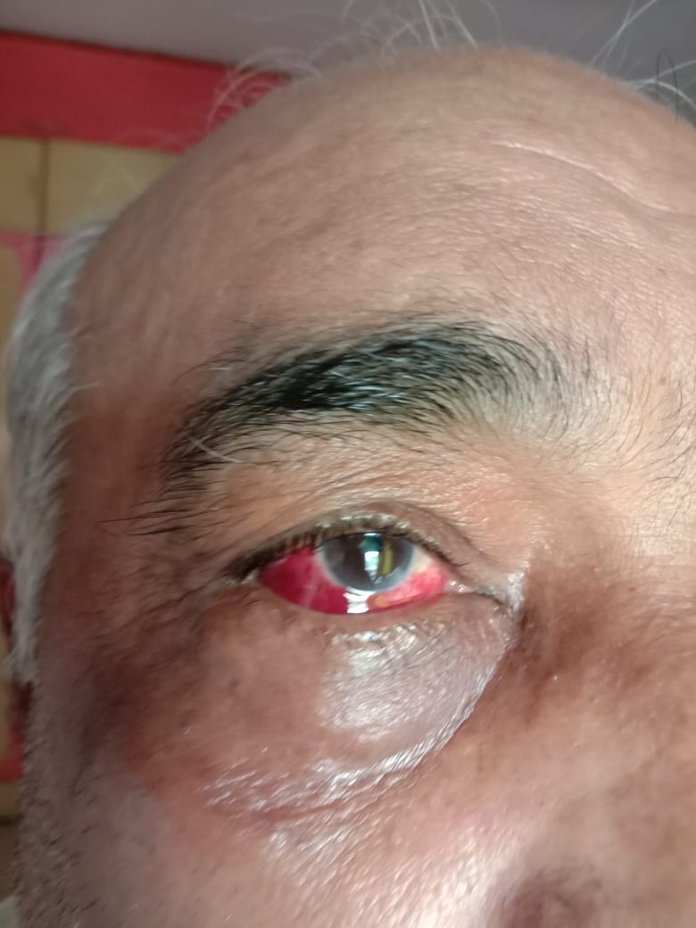 ये है मुंबई के निवृत्त नौसेना अधिकारी मदन शर्मा। इनकी ये भयानक हालत की है शिवसैनिकों ने. 'जुर्म' था मुख्यमंत्री उद्धवजी का कार्टून फॉरवर्ड करने का।
इतनी गुंडागर्दी..जिन्होंने देश के लिए जीवन दिया,उन्हें ही मार रहें हो।
ये बालासाहेब की सेना हो ही नहीं सकती।
(Pic <a href="/BhatkhalkarA/">Atul Bhatkhalkar</a> जी)