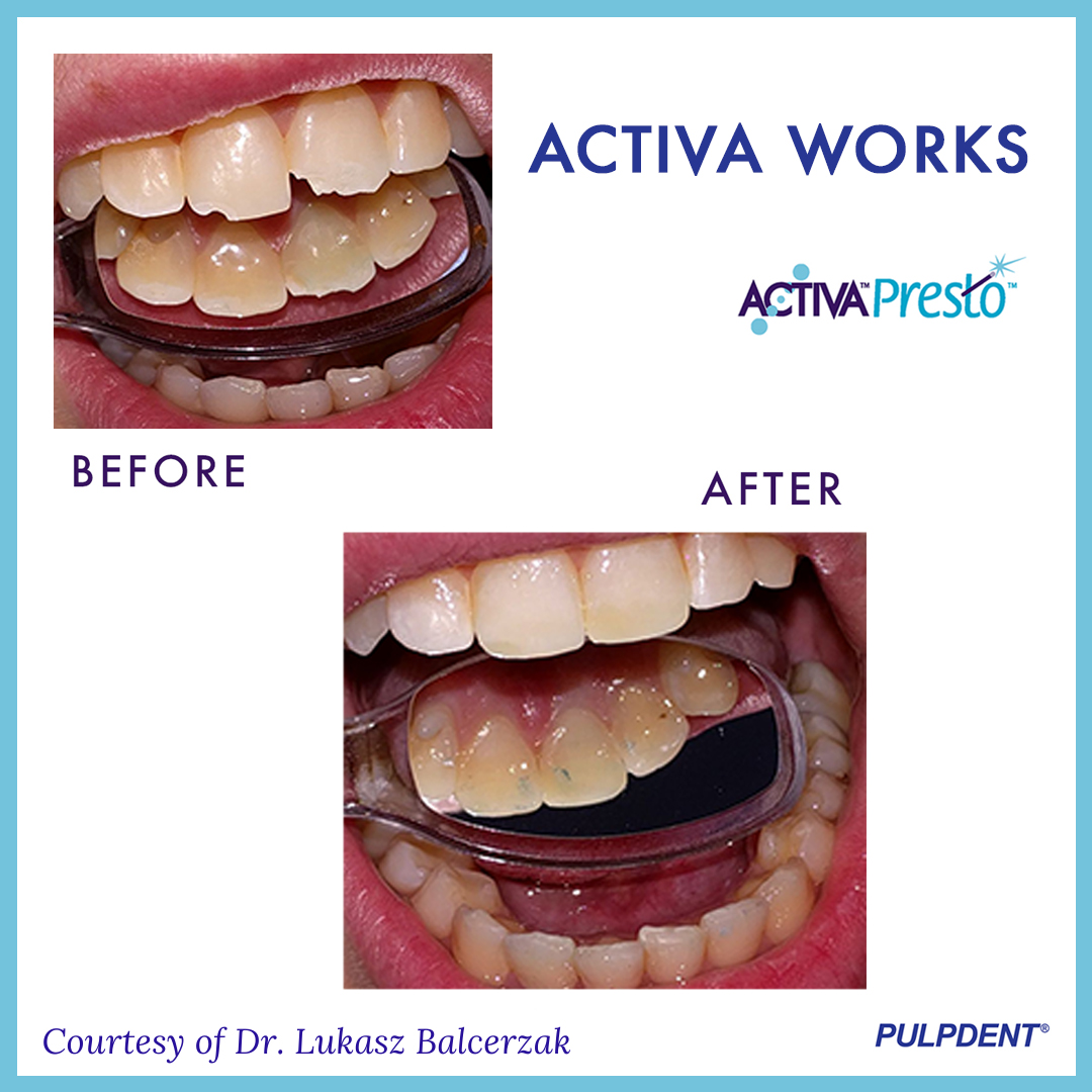 PulpdenTweets's tweet photo. Dr. Lukasz Balcerzak shared these clinical images w/ us after using our newest restorative material, ACTIVA Presto. 🦷✔️ Email your case images 📧: feedback@pulpdent.com #ACTIVAWORKS #ACTIVAPresto #Pulpdent #Dentist #DentalHealth #DentalAssistant #Dental #DentalHygiene https://t.co/V6k4z74y2P
