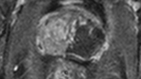 On this day, 14 years ago, Mark Emberton &amp; I treated the very first patient with prostate cancer with focal HIFU.

Immensely grateful to all 20 prostate cancer patients for trusting us to join the first focal trial.

auajournals.org/doi/10.1016/j.…